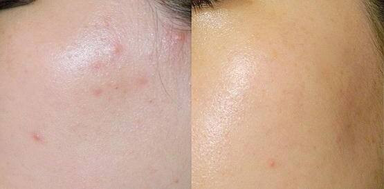 Mụn ẩn là gì? Cách trị mụn ẩn như thế nào?